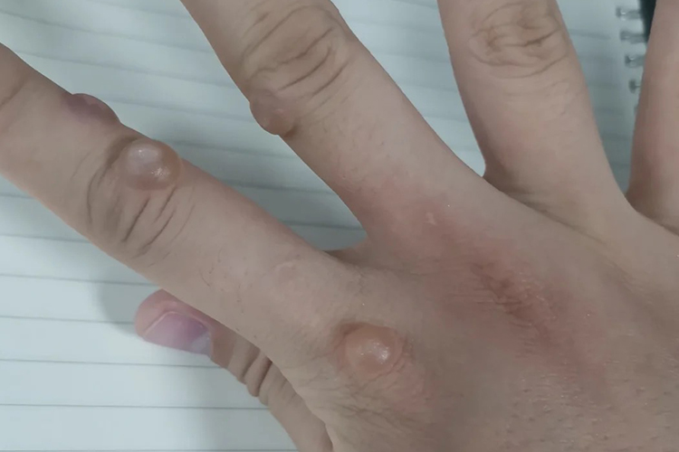 冷冻扁平疣水疱图