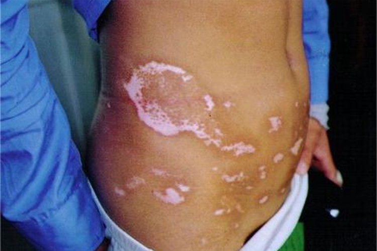 白癜风腹部白点图 白癜风腹部白点图