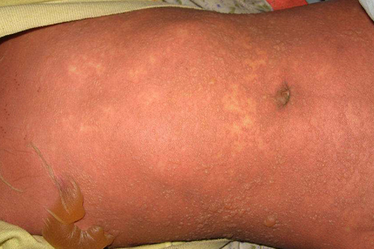 伊曲康唑胶囊过敏起大疱图