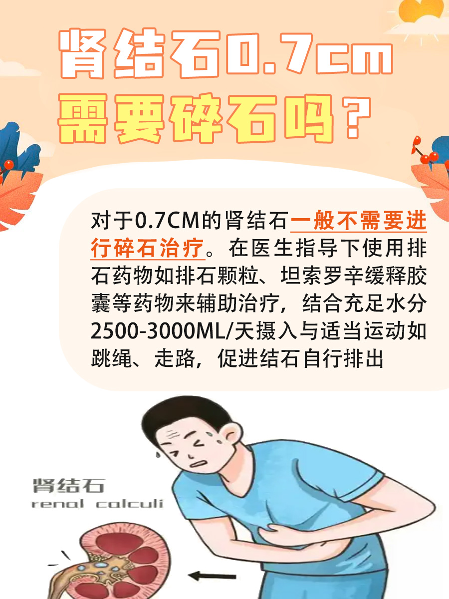 肾结石0.7cm需要碎石吗？一文解析