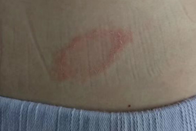 玫瑰糠疹腰部脱屑图 玫瑰糠疹腰部脱屑图