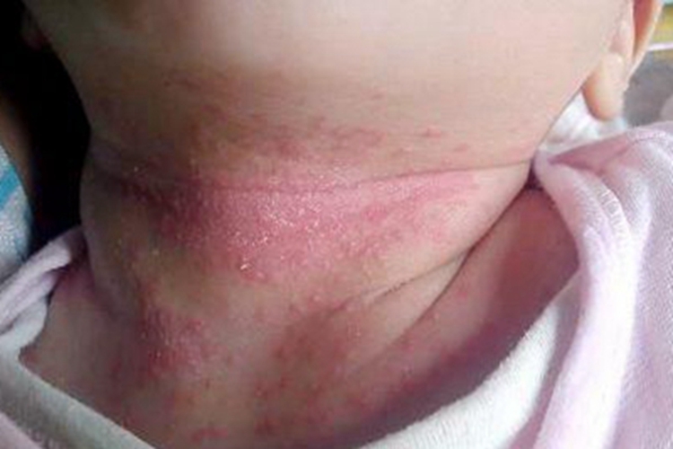 间擦疹前颈症状图