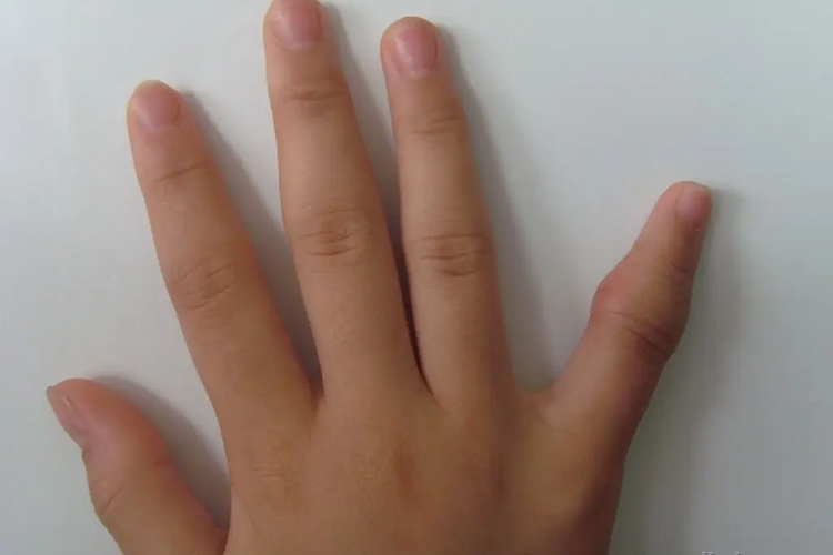 小手指关节处骨头突出图