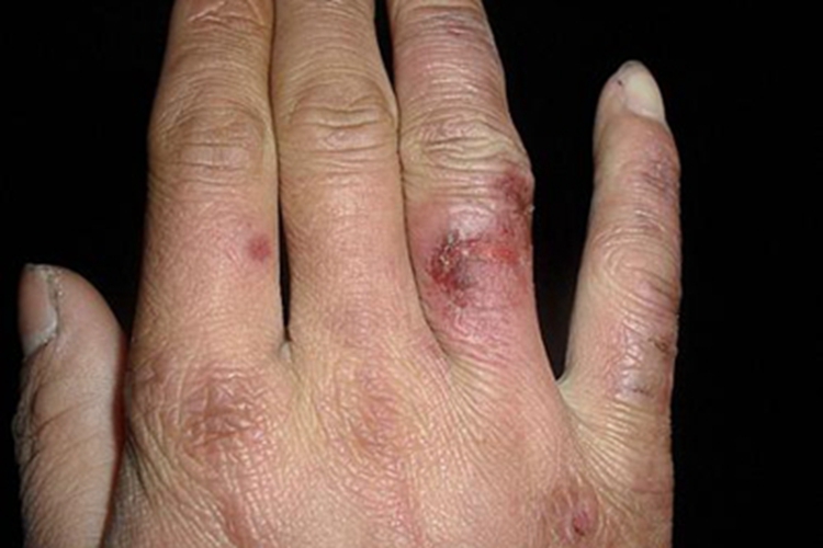 原卟啉病症状图 原卟啉病症状图