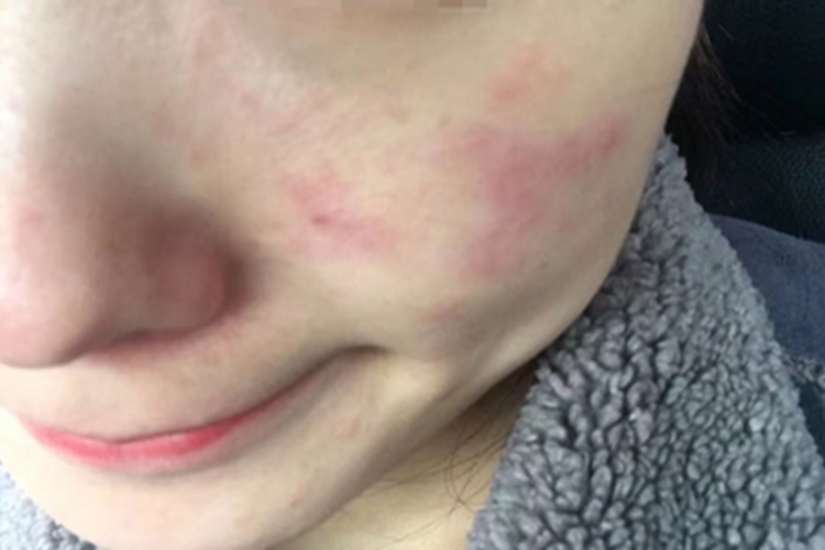 日晒伤脸颊红斑变淡图