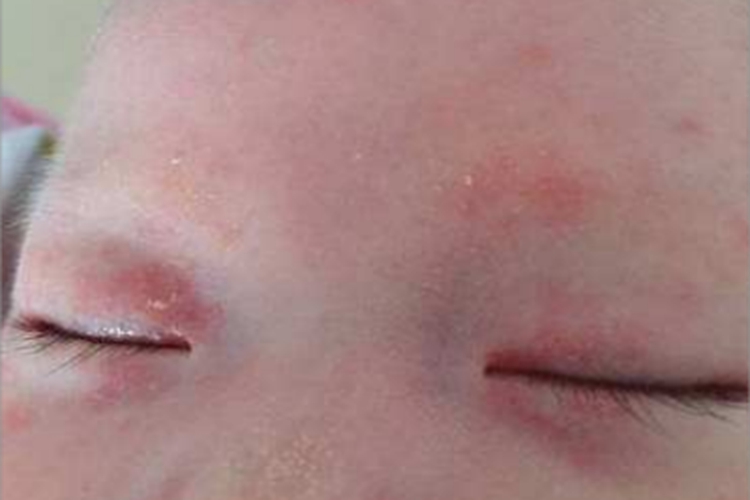 干燥型婴儿湿疹眼睑脱屑图