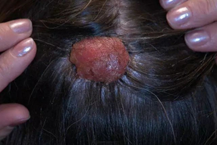 乳头状汗管囊腺瘤头皮疙瘩图