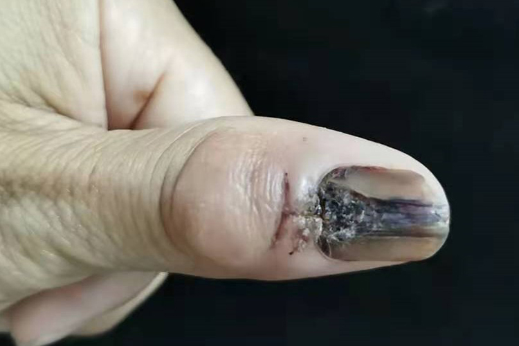 肢端雀斑样痣黑素瘤图