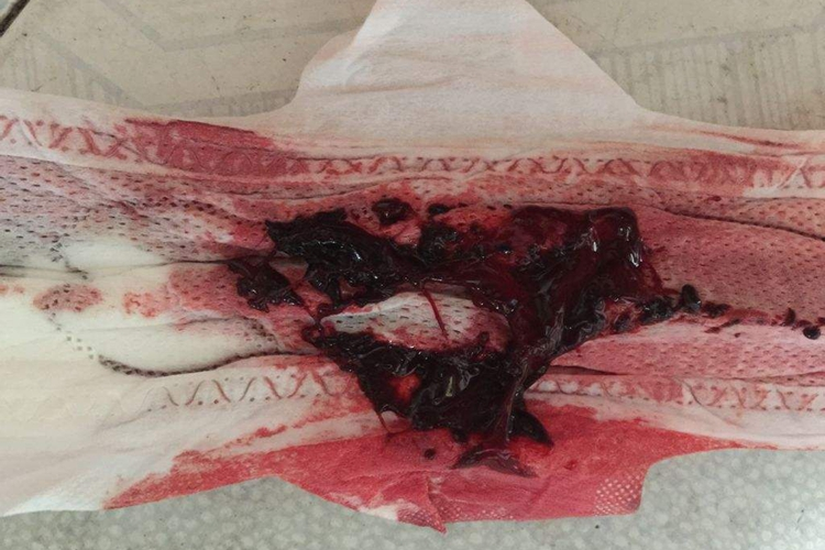 子宫腺肌病月经有血块图 子宫腺肌病月经有血块图