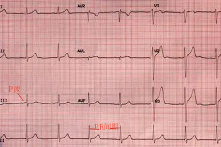 窦性心动过缓心电图 窦性心动过缓心电图