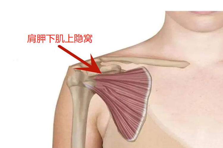 肩胛下肌上隐窝位置图