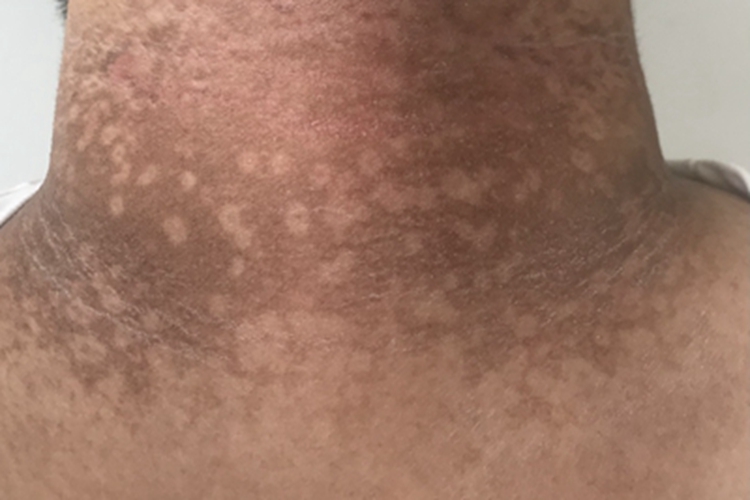 融合性网状乳头瘤病颈部症状图 融合性网状乳头瘤病颈部症状图