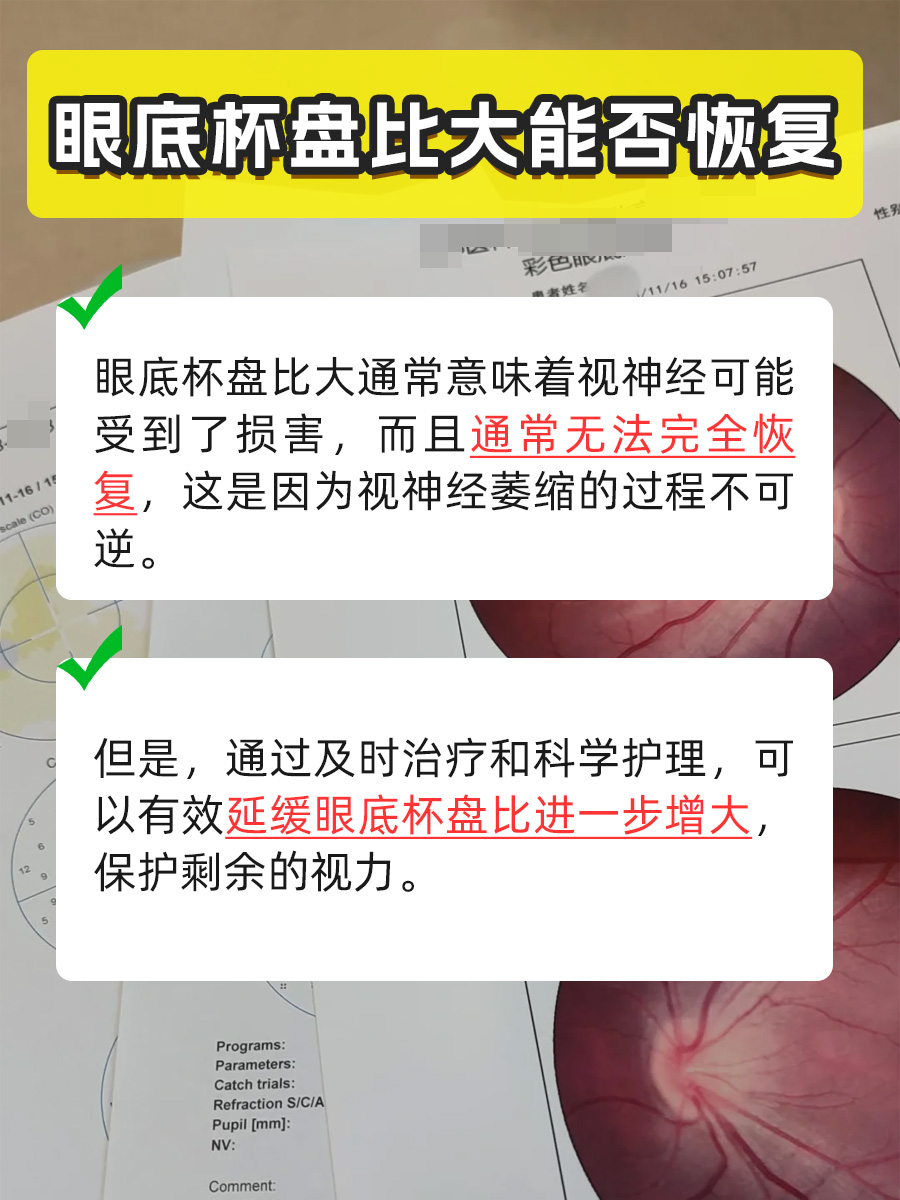 你知道眼底杯盘比大能不能恢复吗？快来看！