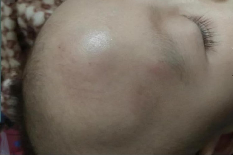 宝宝摔到头骨膜下血肿侧面鼓软包图 宝宝摔到头骨膜下血肿侧面鼓软包图