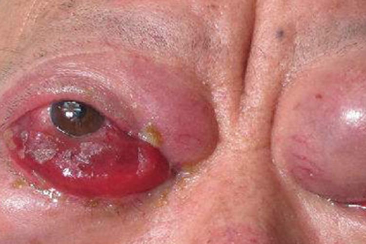 眼眶海绵状血管瘤症状图 眼眶海绵状血管瘤症状图