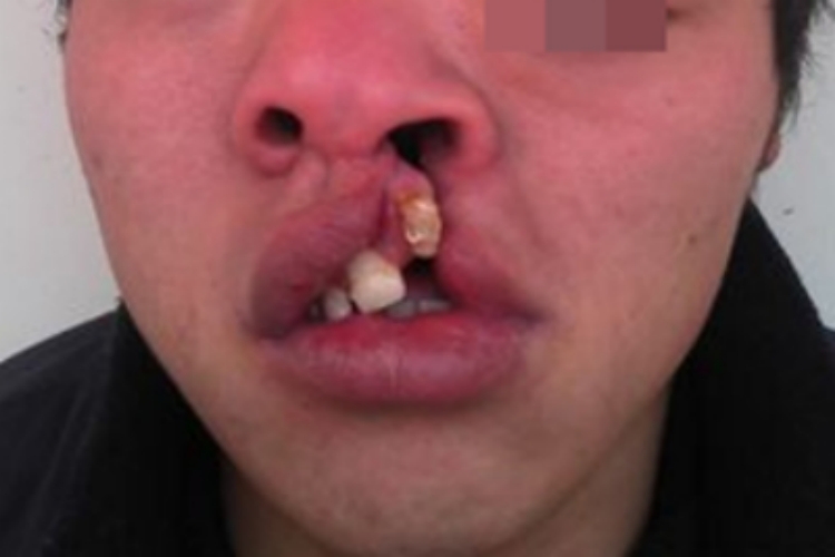 唇腭裂嘴歪鼻孔歪图