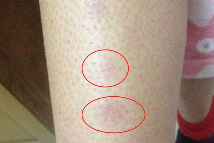 慢性期硬化性脂膜炎硬块图