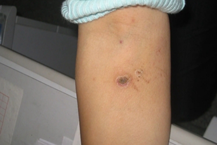 恙螨皮炎胳膊上有黑痂图