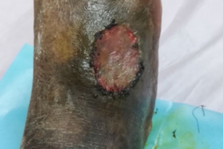 静脉曲张性溃疡皮肤溃疡图