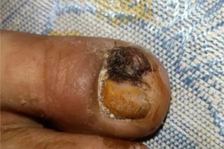 慢性甲沟炎脚趾烂发黑溃烂图