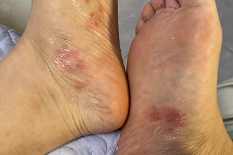 足癣脚底渗液图