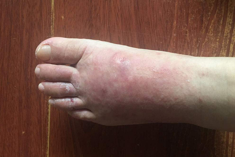 患者脚背过敏时,可出现局部皮肤潮红,肿胀,丘疹,丘疱疹等症状,可伴有