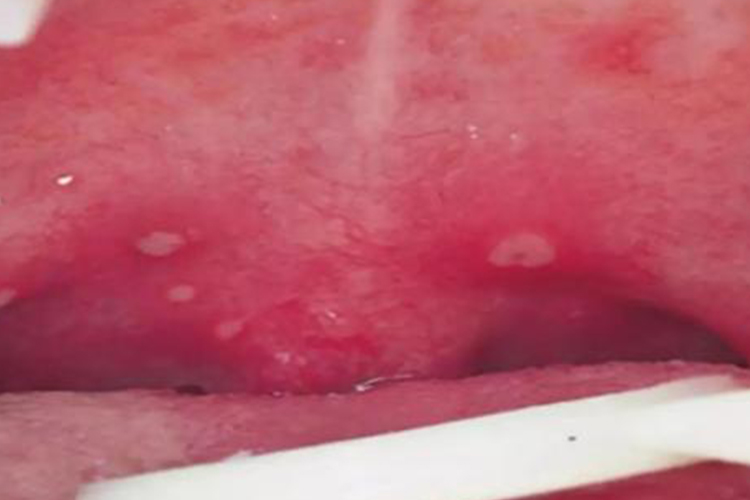 幼儿疱疹性咽峡炎图