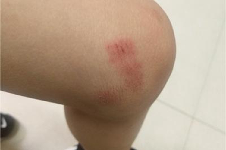 跌伤大腿红肿图 跌伤大腿红肿图