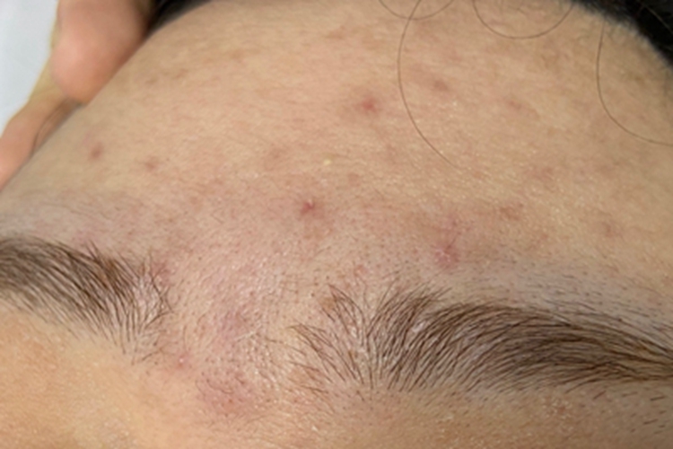 痤疮额头有色素沉着斑图