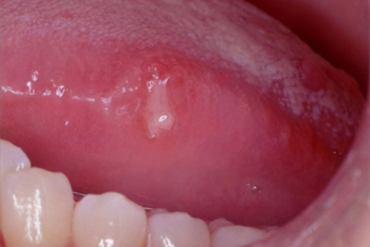 振动性荨麻疹舌头水肿图 振动性荨麻疹舌头水肿图