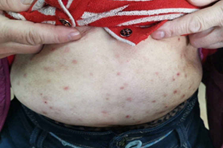 单纯性痒疹腹部小红疙瘩图