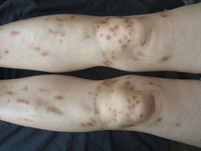 网状色素失禁症的皮肤损害可发生在小腿,临床可表现为局部出现棕褐色