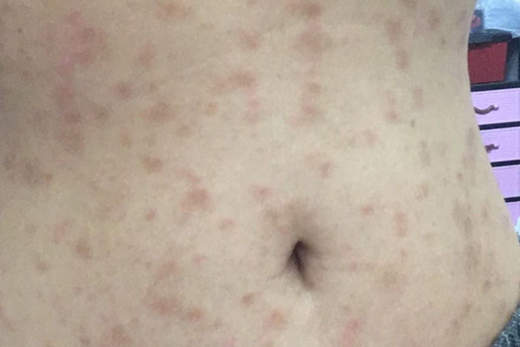 玫瑰糠疹胸下面有红斑图