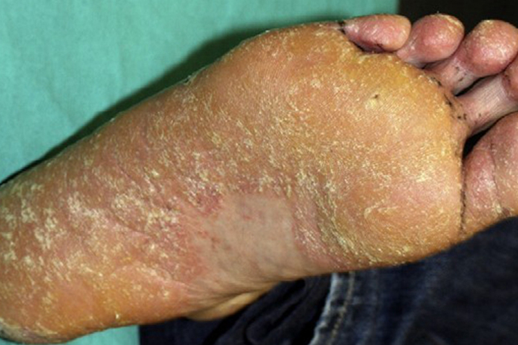 足底寻常型银屑病图