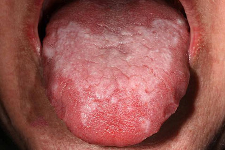 口腔扁平苔藓图