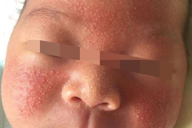 婴儿脸上湿疹图 婴儿脸上湿疹图