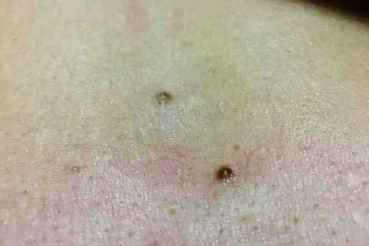 胸口皮肤纤维瘤图 胸口皮肤纤维瘤图