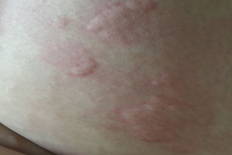 新生儿荨麻疹图 新生儿荨麻疹图