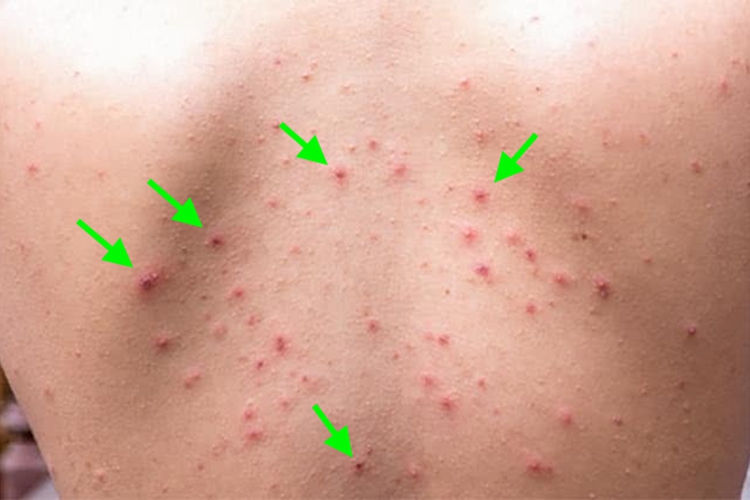 马拉色菌毛囊炎背部血痂图 马拉色菌毛囊炎背部血痂图