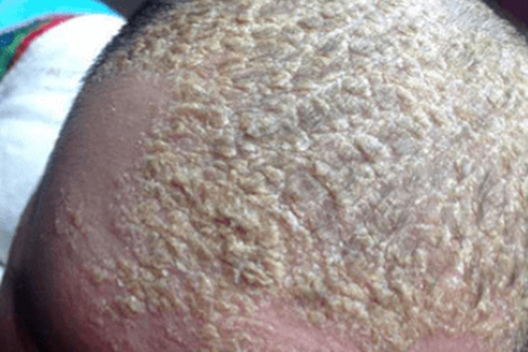 脂溢性皮炎头顶大块头皮屑结痂图