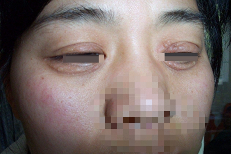 过敏性眼睑皮肤炎皮肤增厚图 过敏性眼睑皮肤炎皮肤增厚图