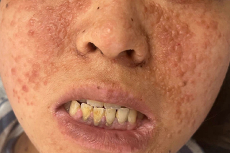 结节性硬化症症状图 结节性硬化症症状图