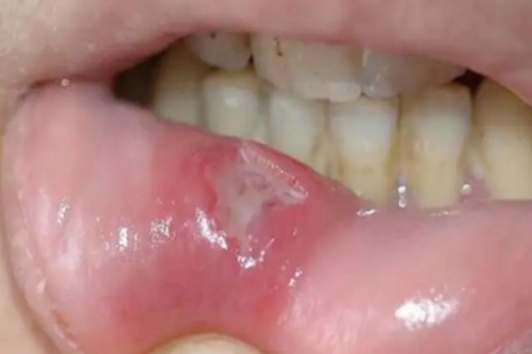 二期口腔梅毒唇内侧溃疡图