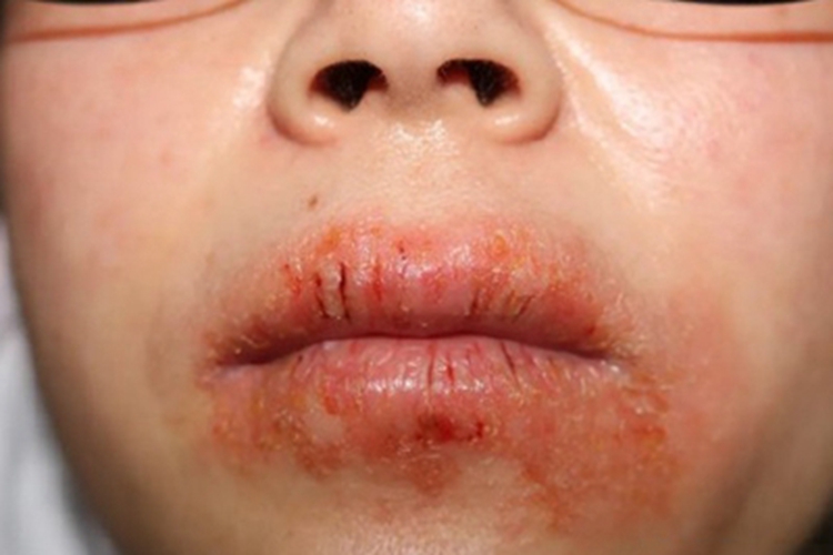慢性唇炎嘴唇裂口有渗出图