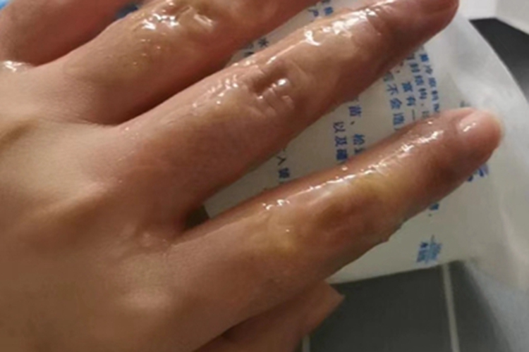 一度烫伤手指红肿图