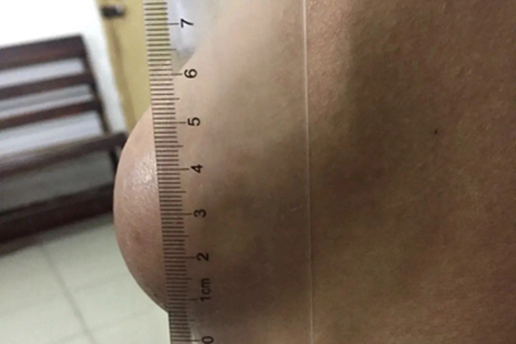 单发性骨软骨瘤大腿症状图 单发性骨软骨瘤大腿症状图