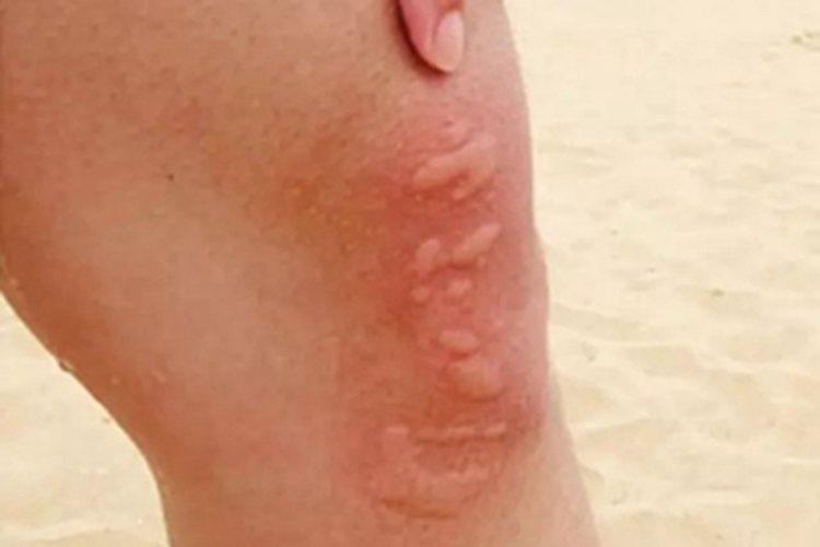 海蜇蜇伤膝盖疙瘩图