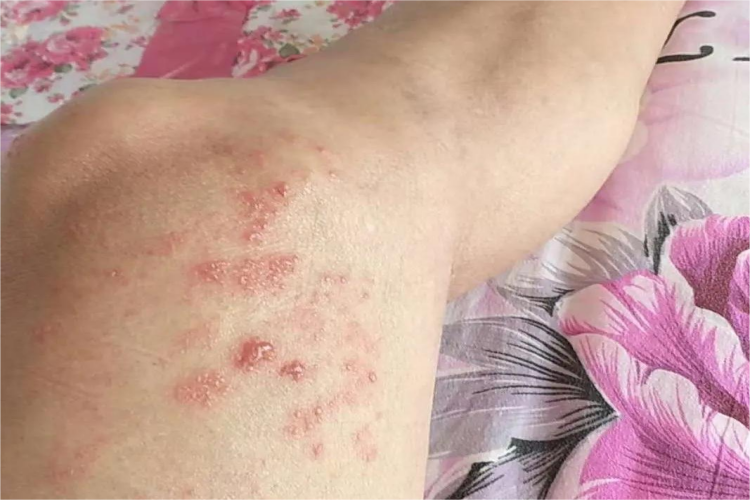 大腿单纯疱疹图 大腿单纯疱疹图