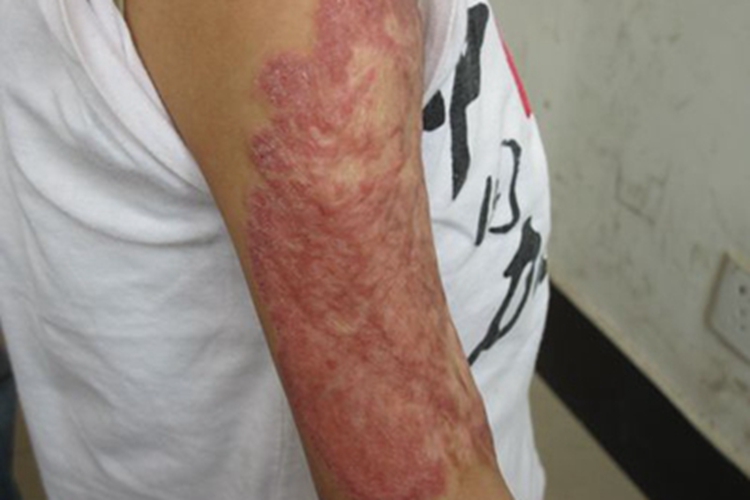 寻常狼疮胳膊症状图