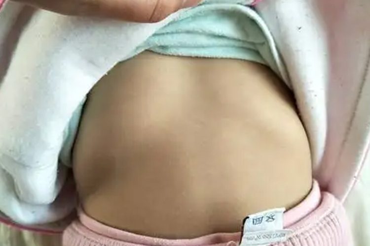 女孩非对称型鸡胸图 女孩非对称型鸡胸图